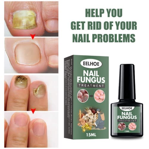 Eelhoe Nail Fungus Treatment - 15ml