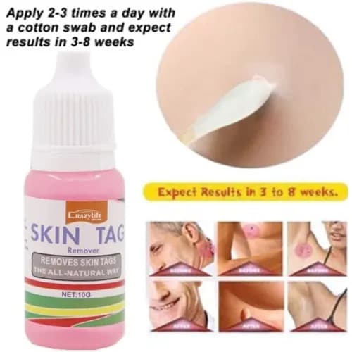 Skin Tag - Mole And Genital Wart / Foot Corn Removal - 10ml