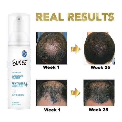 Bunee Signature 5% Minoxidil Hair Growth Treatment